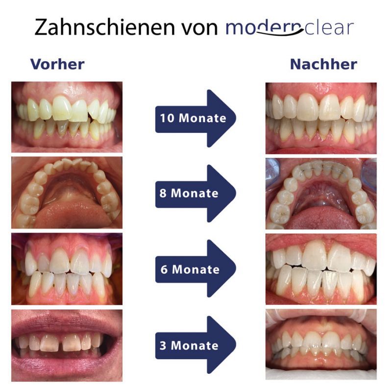 Vorher-Nacher-Bilder-modernclear-